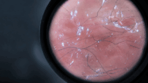 Tick-borne relapsing fever and Morgellons research image showing skin under magnification with fine irregular fibers.