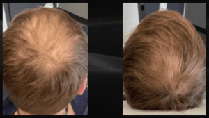 PRP (Platelet-Rich Plasma) Hair Treatment in Regina to Increase Hair Thickness and Density