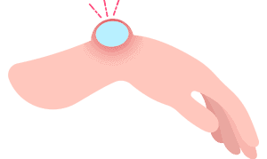 Ganglion Cyst