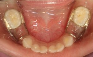 space-maintainers-after