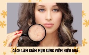 Hướng dẫn làm giảm mụn sưng viêm hiệu quả 