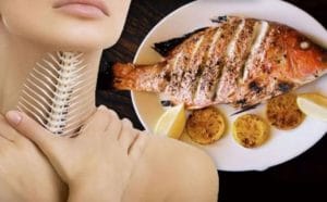 Cách chữa hóc xương cá nhanh