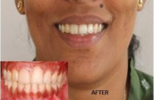 smile-esthetics-after