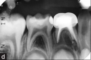 Pulpectomy-after
