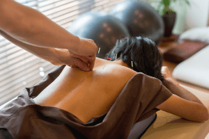 acupuncture