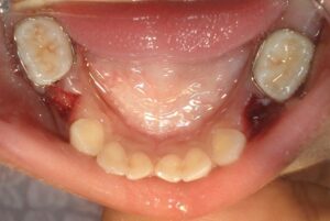 space-maintainers-before