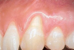 Recession-Coverage-Before