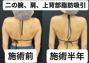 上背部の脂肪吸引