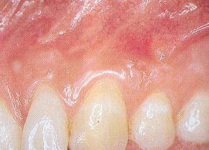 Recession-Coverage-After