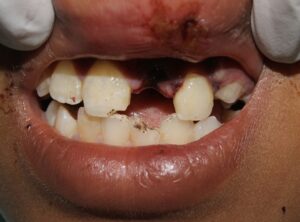 Replantation_of_tooth_post_trauma_Before