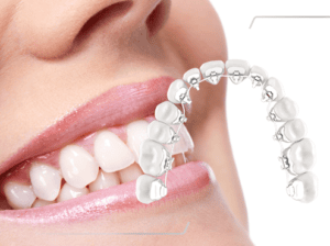 Win lingual orthodontics , lingvālās breketes WIN