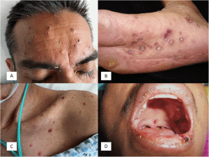 Symptoms of Histoplasmosis in Humans