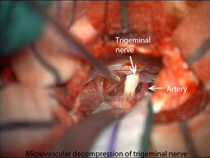 Microvascular-Decompression-of-the-Trigeminal-Nerve