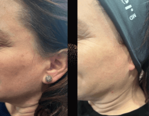 Master the Art of Skin Rejuvenation Treatments with Visage’s Intense Pulse Light (IPL) Training Course in Regina