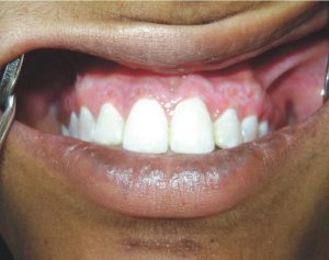 Depigmentation-After