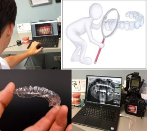 Clear aligners consultation