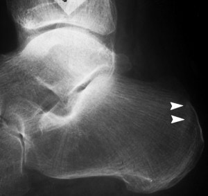 An x-ray showing a stress fracture of the calcaneus (heel bone) mimicking plantar fasciitis.