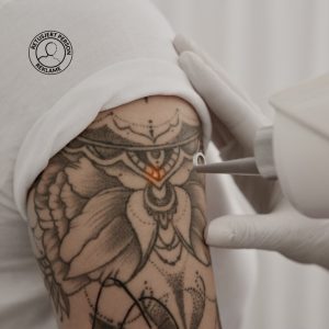 fjerning av tatoveringer med Picosecond Laser