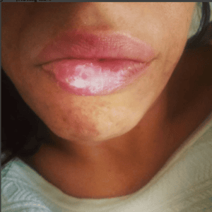 ¿Cuanto Tiempo Tarda En Hacer Efecto El Aciclovir Crema? 1 ¿Cuanto Tiempo Tarda En Hacer Efecto El Aciclovir Crema?