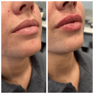 Lip Filler Treatment in Regina, Dermal Filler Treatment in Regina
