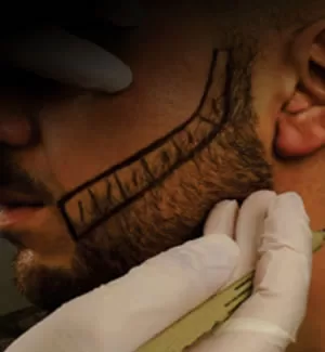 Transplante de Barba em Goiânia