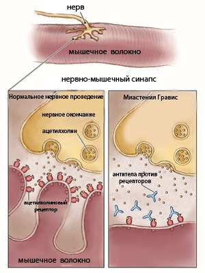Разница между болезнью Паркинсона и Миастенией 3 Механизм развития Миастении