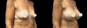 PSSVA Breast Lift Procedures Patient 1b