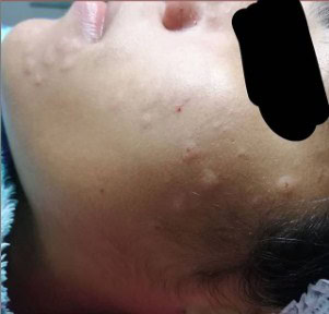 Como-Curar-Una-Alergia