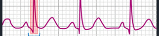 QRS estrecho taquicardia ventricular