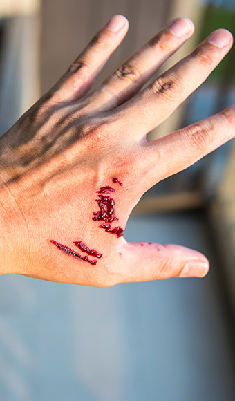 Dog Bites-Image1 Dog Bites-Image1