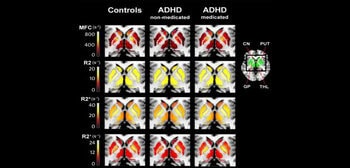 MRI technique may help prevent ADHD misdiagnosis