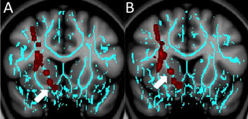 Brain injury patterns linked to post-concussion depression and anxiety