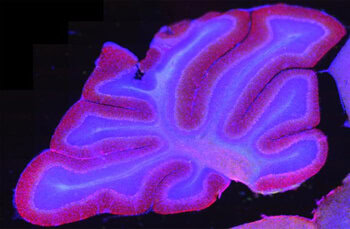 Brain stimulation improves schizophrenia-like cognitive problems