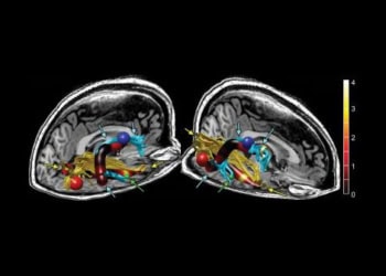 Stanford study finds brain abnormalities in chronic fatigue patients