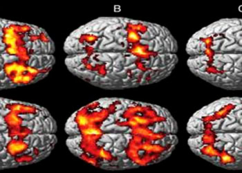 Women show persistent memory impairment after concussion