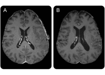 Study reveals structural brain changes caused by chemoradiation in glioblastoma patients