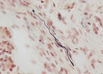 Researchers identify tissue biomarker for dementia with lewy bodies and Parkinson’s disease