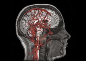 Cerebrovascular disease linked to Alzheimer’s disease