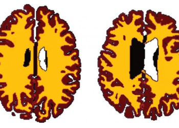Brains of overweight people ‘ten years older’ than lean counterparts at middle-age