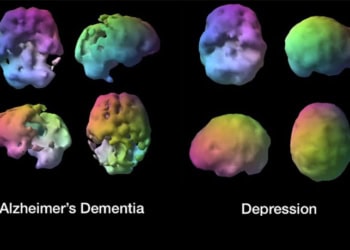Is it depression or dementia? Brain SPECT imaging helps distinguish them