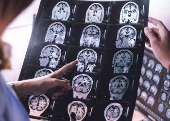 Neuroimaging research suggests that even mild cases of COVID-19 leave a lasting mark on the brain