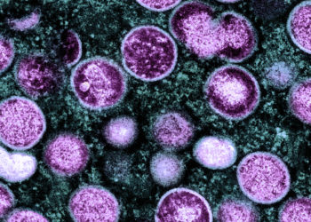 Monkeypox may cause severe neurological complications in a small proportion of infected individuals