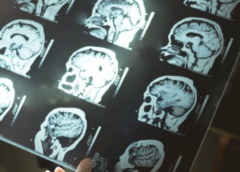 Neuroimaging study suggests serotonin reuptake inhibitor treatment can improve brain ventricle volume