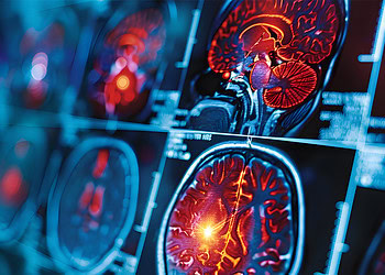 Inflammation from severe COVID-19 can damage brainstem, leading to prolonged symptoms, new research suggests