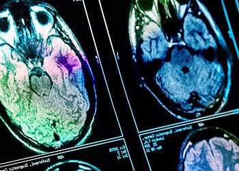 Childhood adversity may blunt brain development rather than speed it up