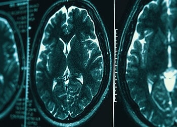 Traumatic brain injury may steer Alzheimer’s pathology down a different path