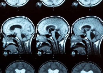 Biomarkers in spinal fluid may flag frontotemporal dementia before symptoms emerge