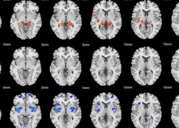 Brain scans reveal two distinct physical subtypes of ADHD