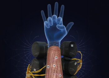 Magnetic muscle implants help amputees feel coordinated prosthetic hand movements