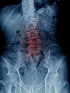 X-ray of the spine